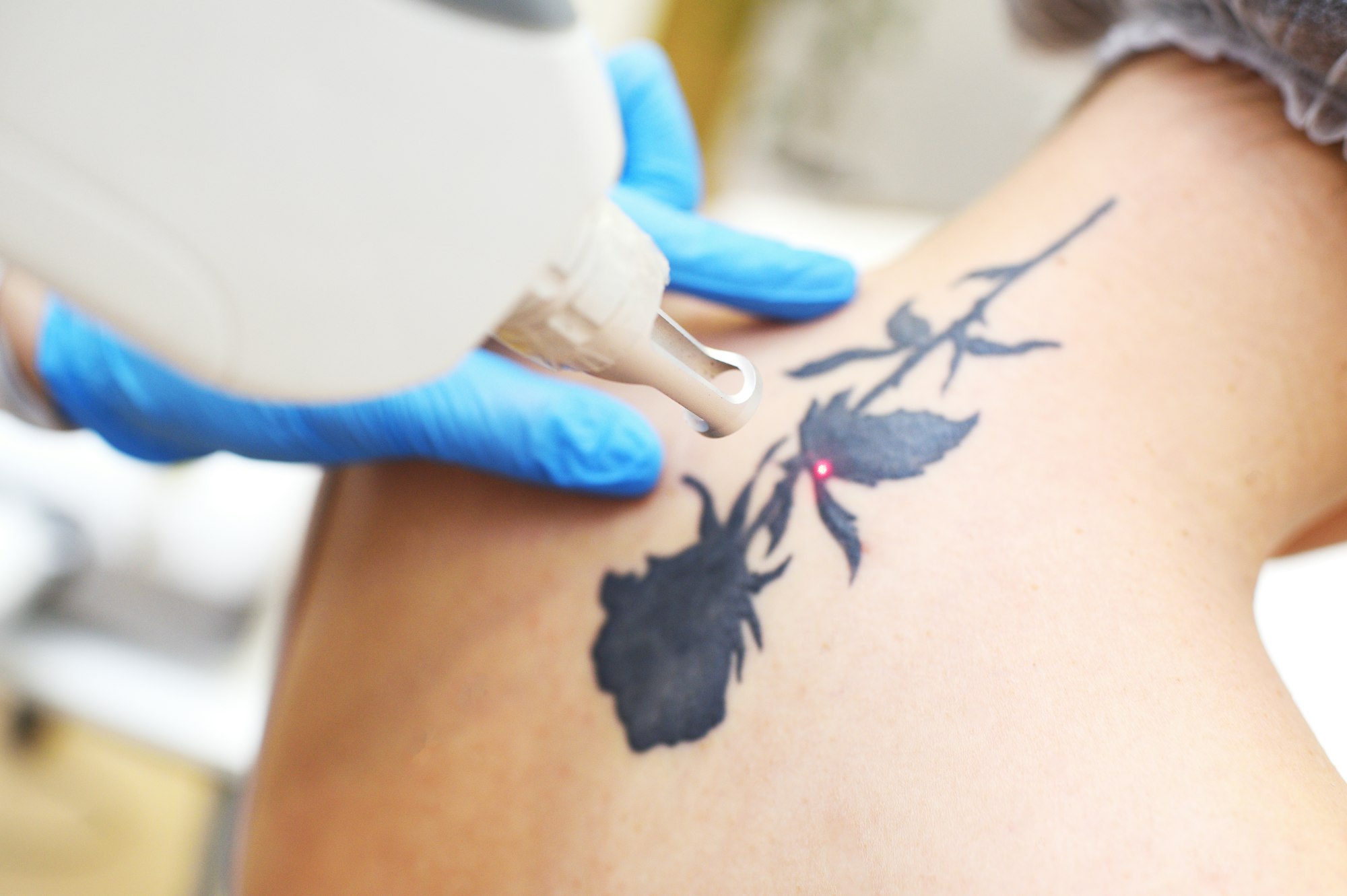 Pico-Laser entfernt ein schwarzes Rosen-Tattoo auf dem Rücken einer Patientin