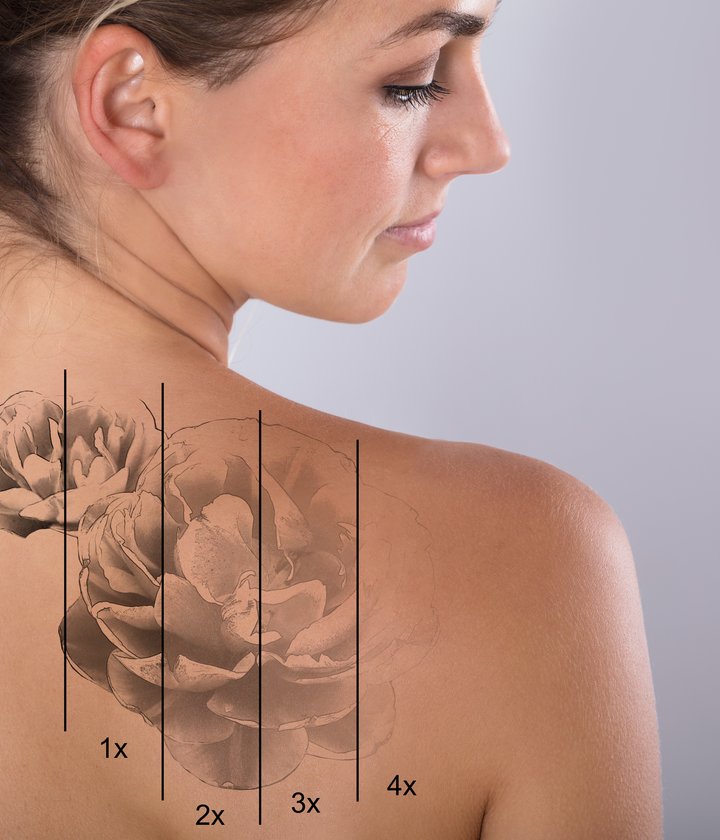 Beratungs- und Behandlungssituation bei der Tattooentfernung