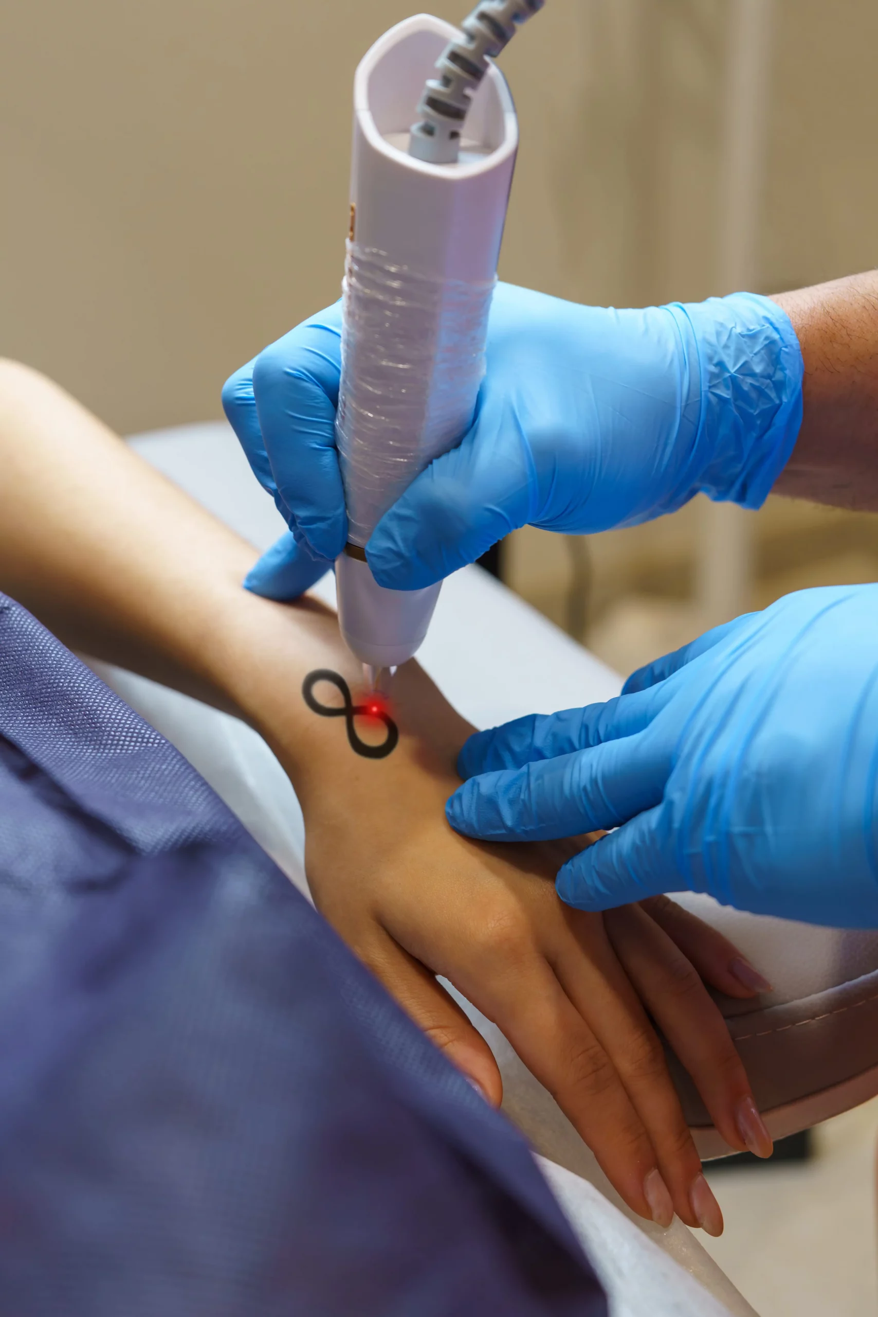 Behandler entfernt mit dem Pico-Laser ein Tattoo am Handrücken einer Patientin